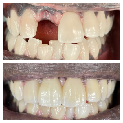 Bridge to address missing front tooth