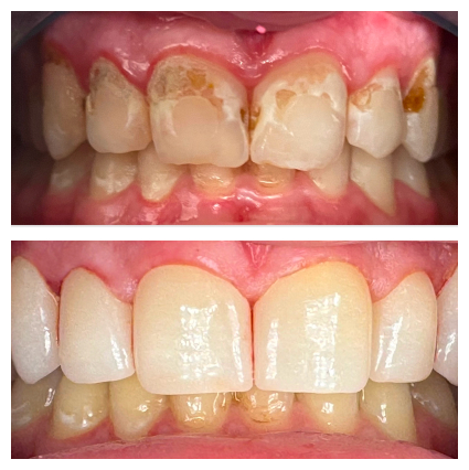 Crowns to address decay