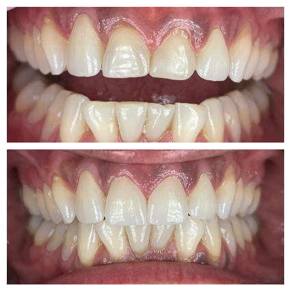 Veneers to address front teeth discoloration and cosmetic concerns