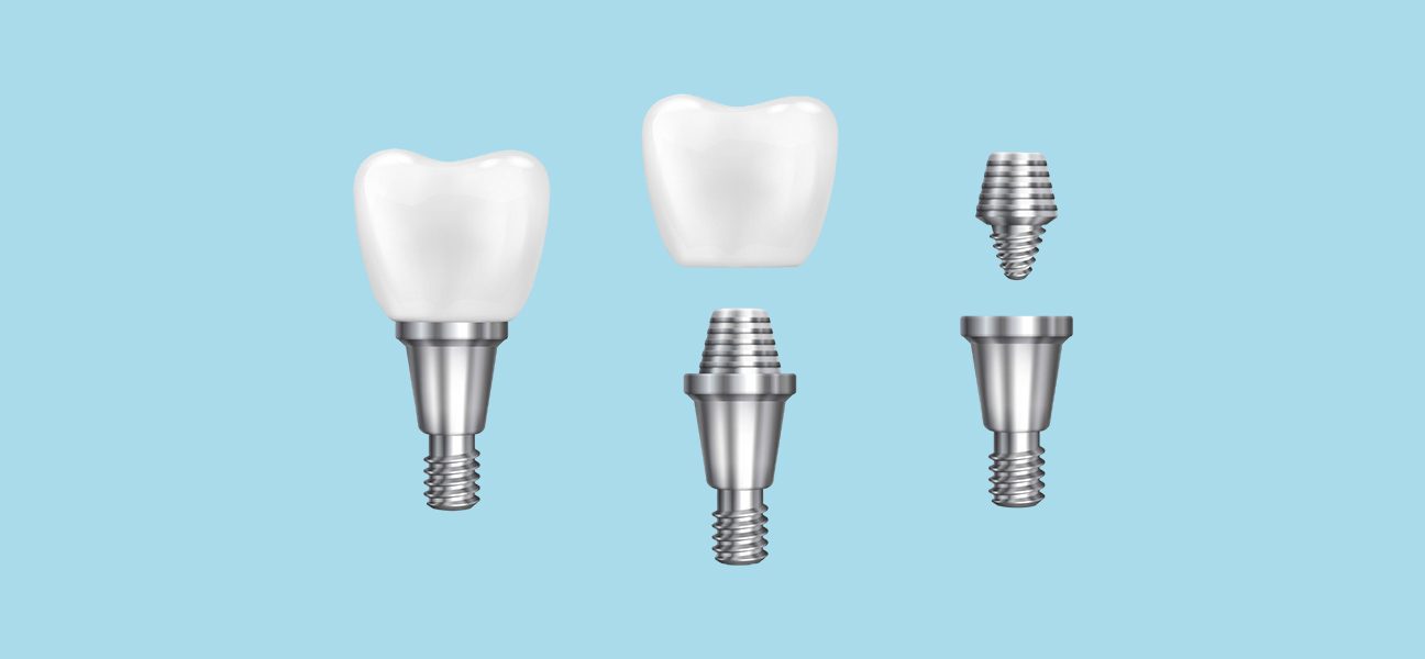 Who Is Best Qualified to Do Dental Implants? Understanding Your Options