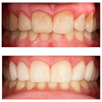 Crowns to address decay