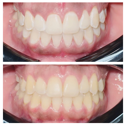 Zoom in office whitening procedure
