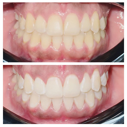 Zoom in office whitening procedure