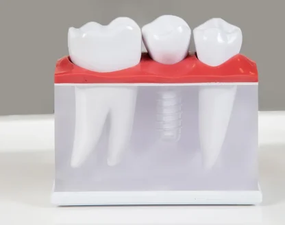 Are-Dental-Implants-Better-Than-Dentures-or-Bridges 
